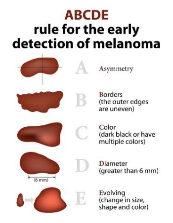 ABCDE rules for early detection of melanoma
