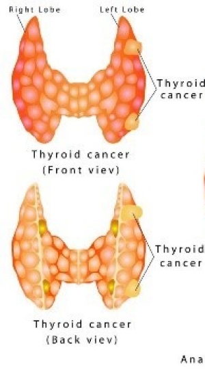 thyroid cancer front and back views