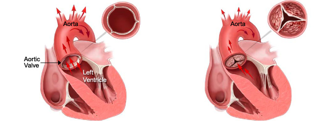 Aorta And Aortic Valve