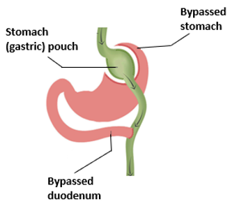 Gastirc Bypass