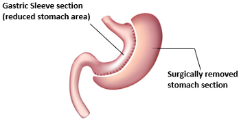 Sleeve Gastrectomy