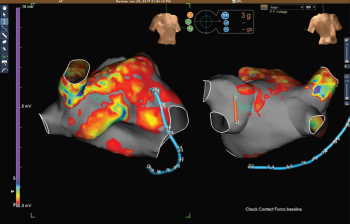 computerized rendering of the left atrium showing atrial fibrillation