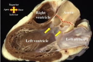 Aortic root
