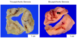 Congenital Bicuspid Aortic Valve Stenosis, Compared with Atherosclerotic Tricuspid Aortic
