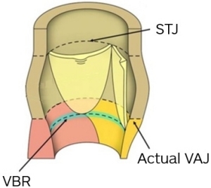 Opened aortic root