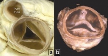  Tricuspid, bicuspid