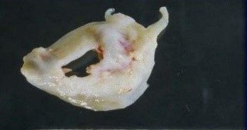 unicuspid 