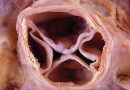  quadricuspid valves	