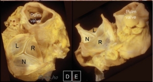 Specimen showing free margins and commissures