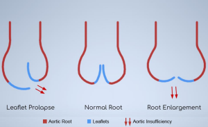 Changes in root dimensions and leaflet prolapse causing AI