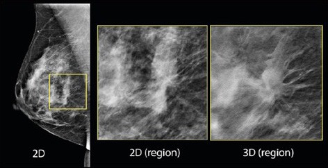 3D-mammography