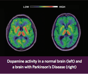 Dopamine brain activity vs Parkinson's Disease Brain