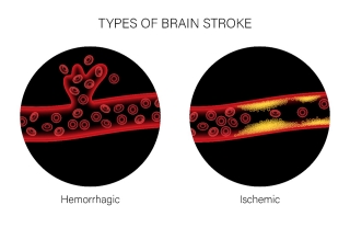 Types of Brain Strokes