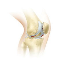 knee replacement image after